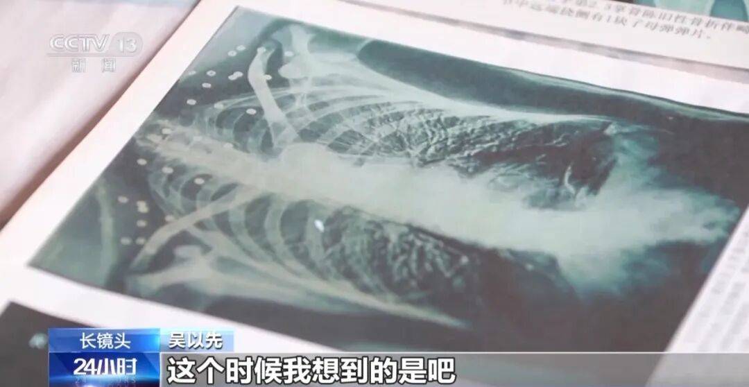 皇冠信用怎么弄_“老先生皇冠信用怎么弄，您把项链取下来再做CT”“你看是不是弹片”